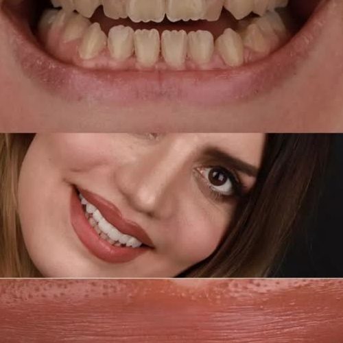 10 نکته جلوگیری از پوسیدگی دندان(10 tips to prevent tooth decay) که دندان های شما را میتواند تا ابد سالم و صحیح نکهدارد.