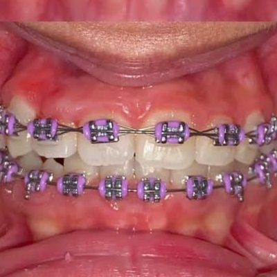 همه چیز درباره ارتودنسی دندان(orthodontic-treatment)