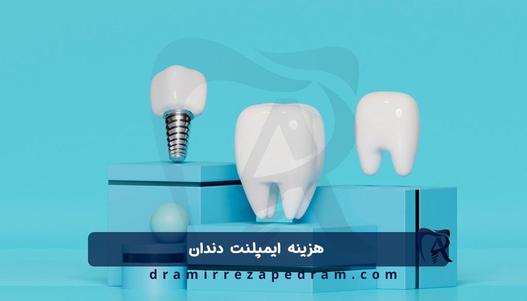 هزینه ایمپلنت دندان