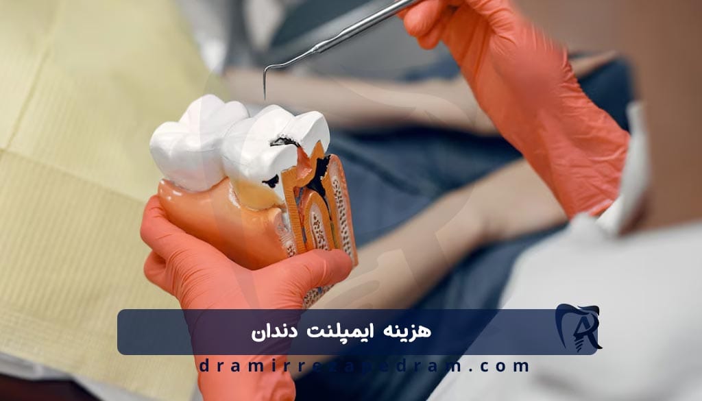 قیمت ایمپلنت دندان