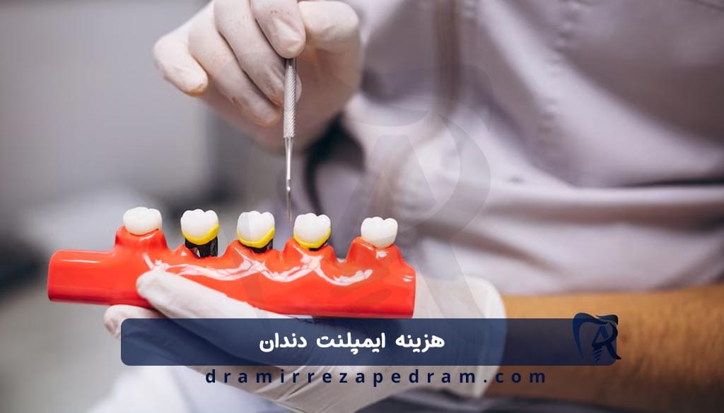 قیمت ایمپلنت دندان