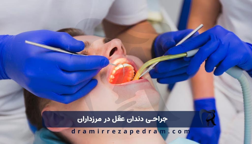 جراحی دندان عقل