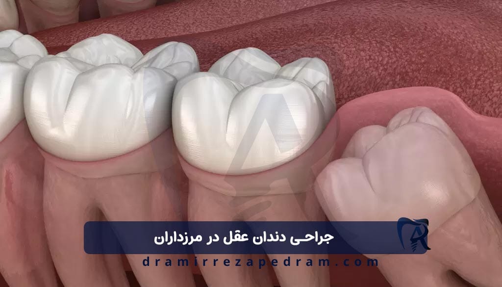 جراحی دندان عقل