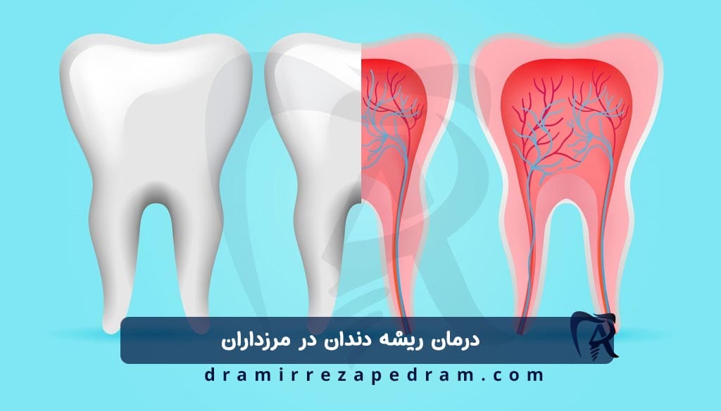 درمان ریشه دندان