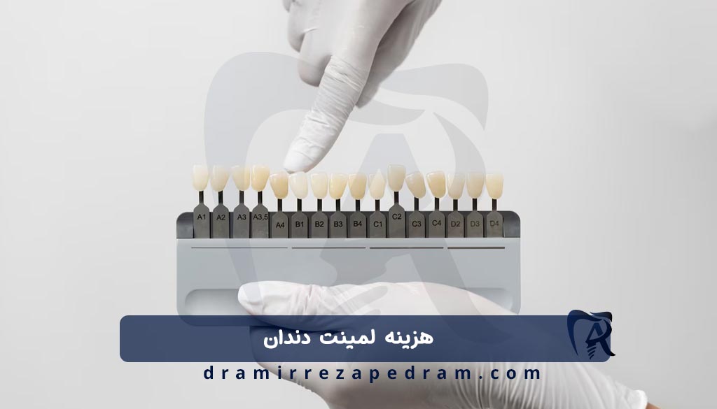 هزینه لمینت دندان
