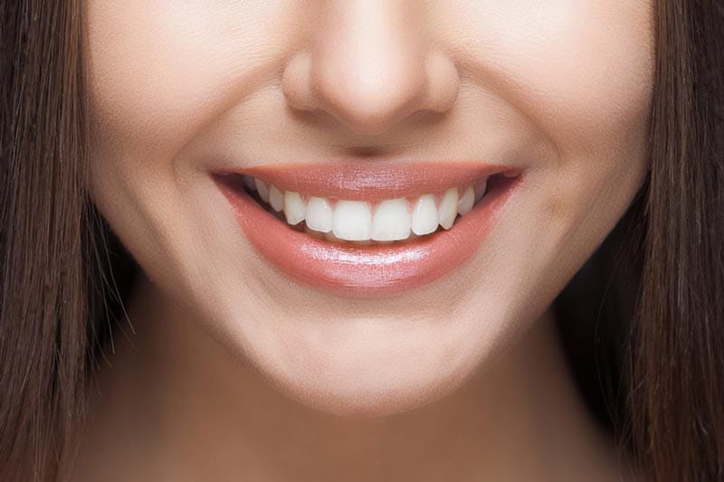 مراحل انجام و شرایط مناسب لمینت دندان چیست؟