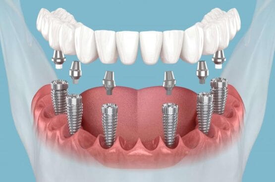 عوارض ایمپلنت دندان: چه چیزی باید بدانید؟