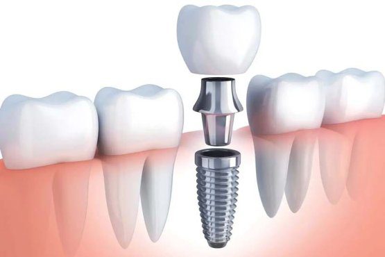 بهترین برند های ایمپلنت دنیا چیست؟