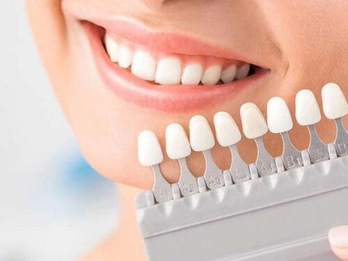 لمینت دندان: چه زمانی باید از آن استفاده کنیم؟