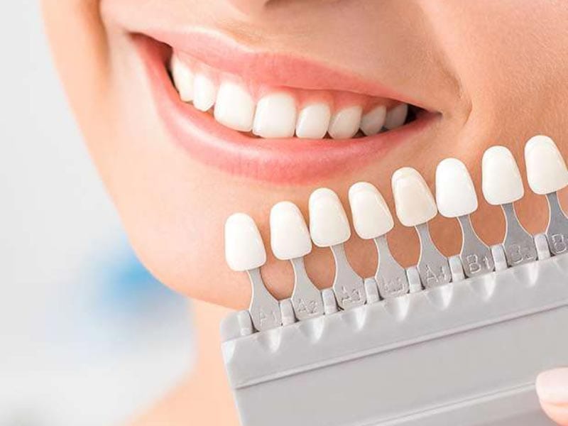 لمینت دندان: چه زمانی باید از آن استفاده کنیم؟