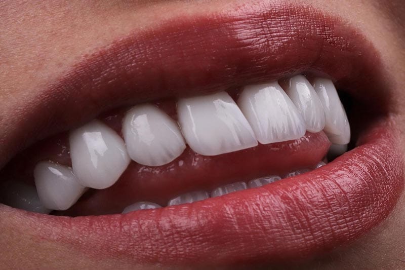 لمینت دندان چیست