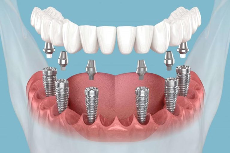 عوارض ایمپلنت دندان: چه چیزی باید بدانید؟