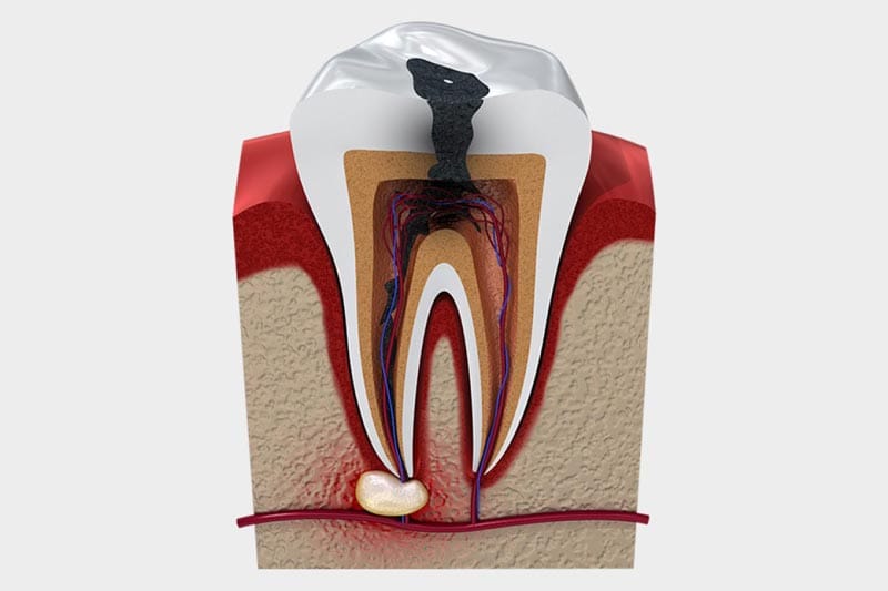 روش های پیشگیری از پوسیدگی دندان