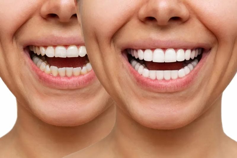 قبل و بعد لمینت دندان