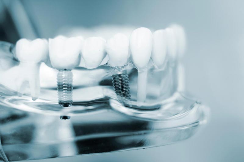 چگونه از عوارض رایج ایمپلنت جلوگیری کنیم؟