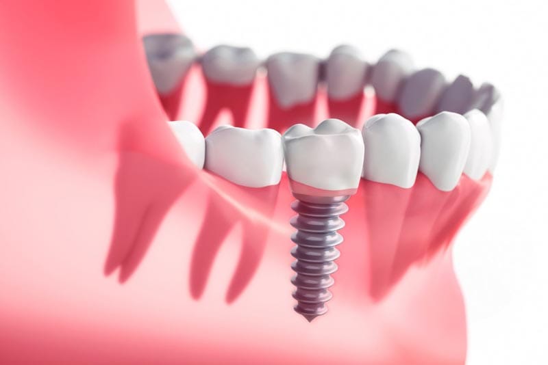 برخی عوارض ایملنت دندان کوتاه مدت هستند و با رعایت برخی نکات از بین می روند.