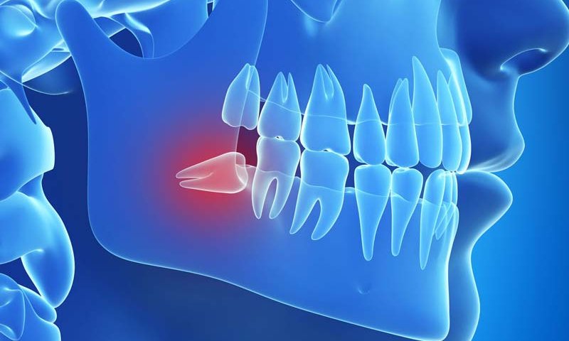 بهترین آنتی بیوتیک بعد از کشیدن دندان عقل