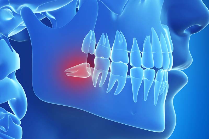 بهترین آنتی بیوتیک بعد از کشیدن دندان عقل