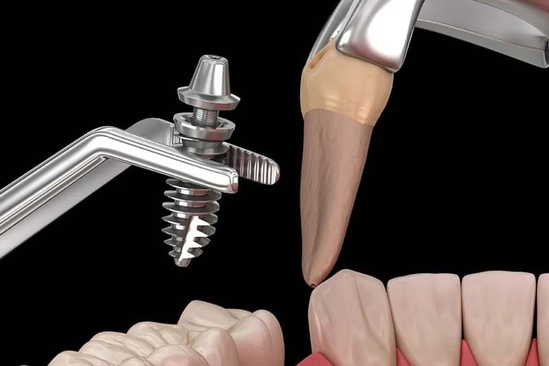 منظور از فیکسچر ایمپلنت دندان اس پی ای چیست؟