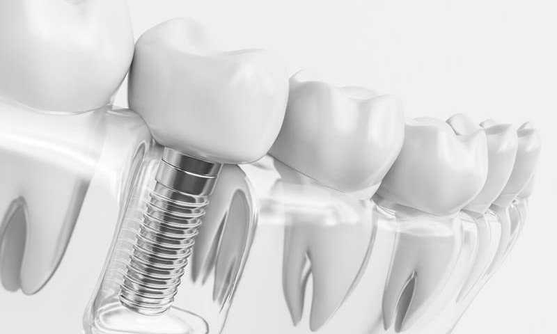 ایمپلنت اشترومن