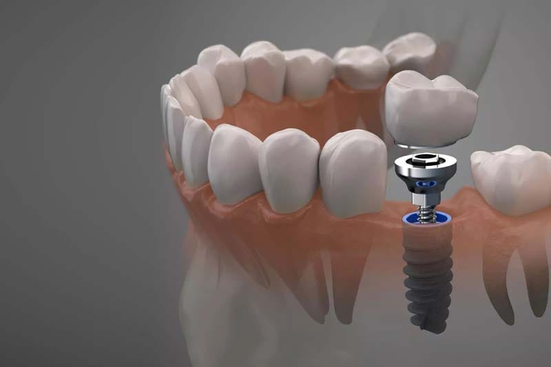 مزایای ایمپلنت اشترومن چیست؟