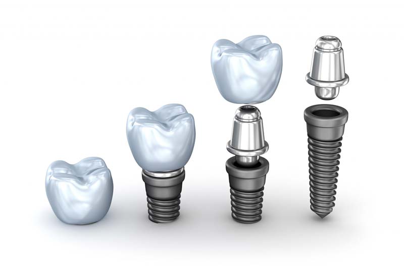 ایمپلنت زیمر چیست؟ انواع فیکسچر های آن کدامند؟