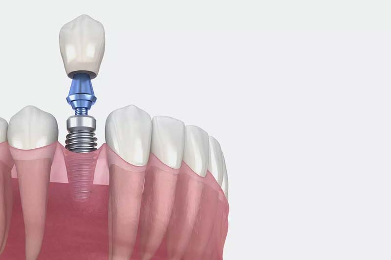 هزینه ایمپلنت بایکان چند است؟