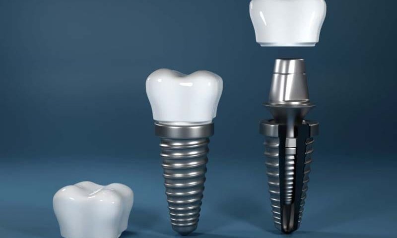 ایمپلنت بایوتم کره