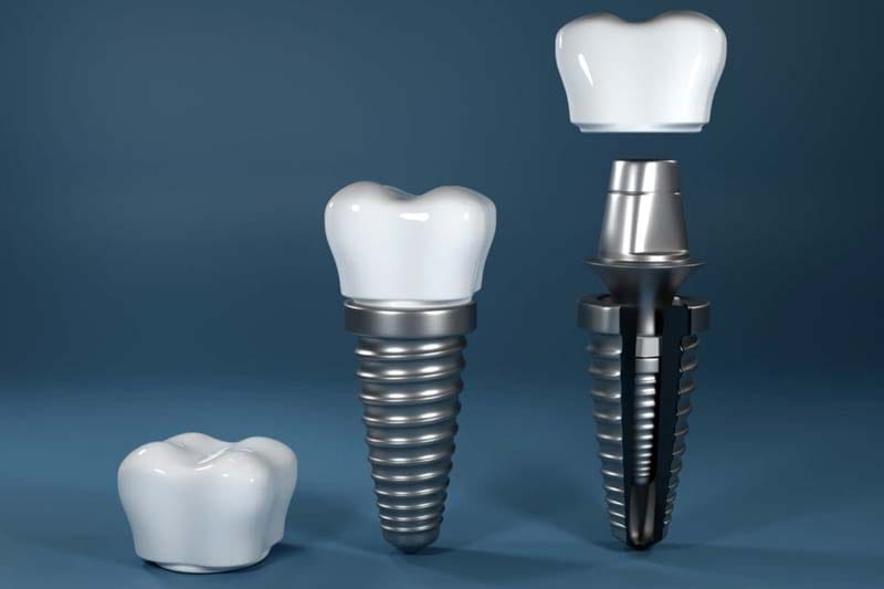 ایمپلنت بایوتم کره