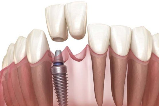 معایب برند ایمپلنت دندان اسنوکن چیست؟