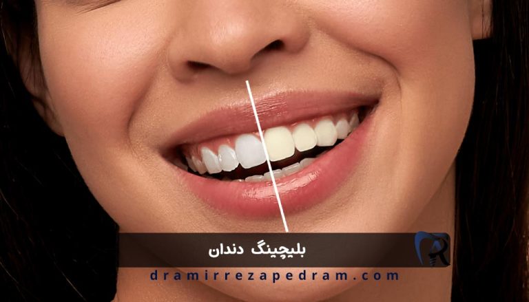بلیچینگ دندان در ستارخان تهران