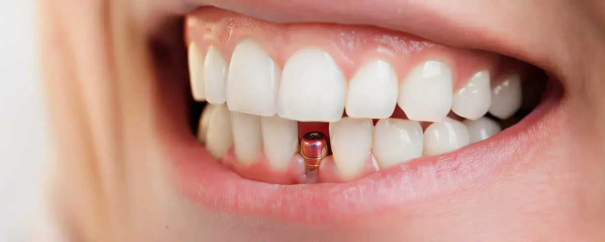 ایمپلنت دندان در مرزداران | اقساطی، بدون درد و با ضمانت