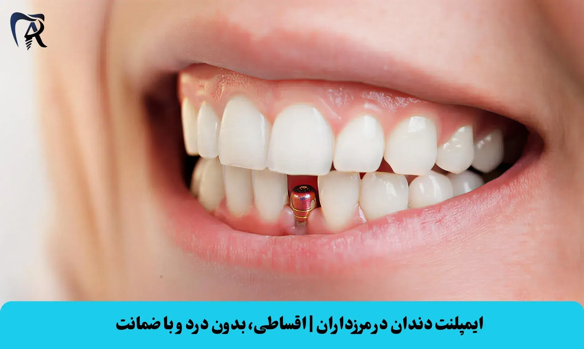 ایمپلنت دندان در مرزداران | اقساطی، بدون درد و با ضمانت
