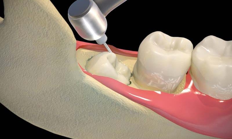 درد جراحی دندان عقل چند روز طول میکشد؟