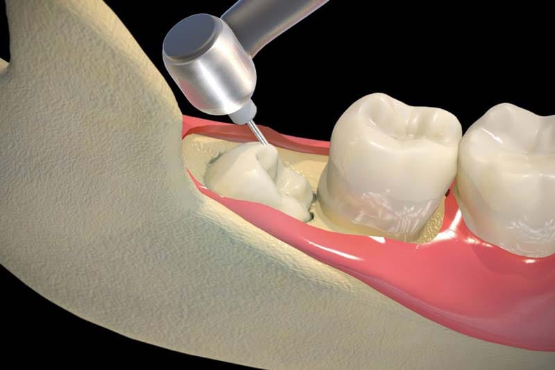 درد جراحی دندان عقل چند روز طول میکشد؟