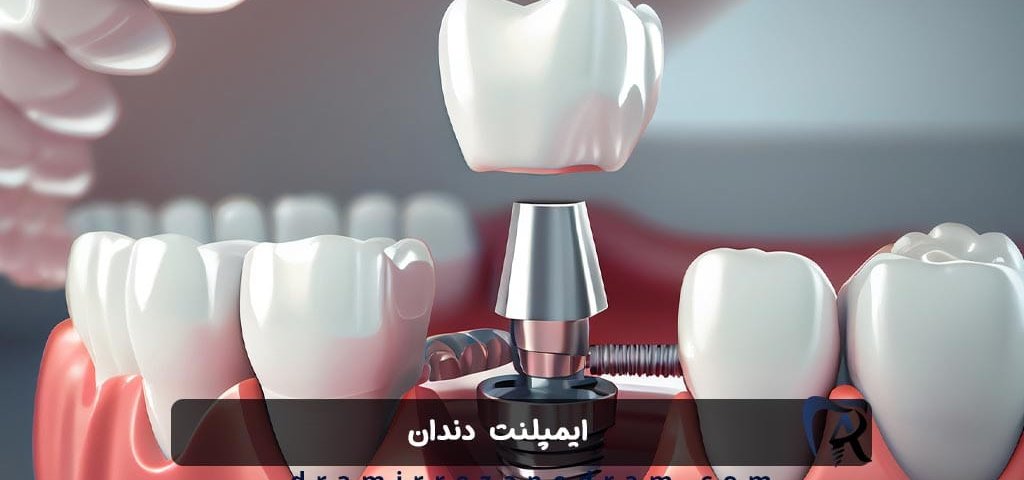 ایمپلنت دندان در ستارخان تهران