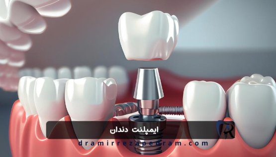 ایمپلنت دندان در ستارخان تهران