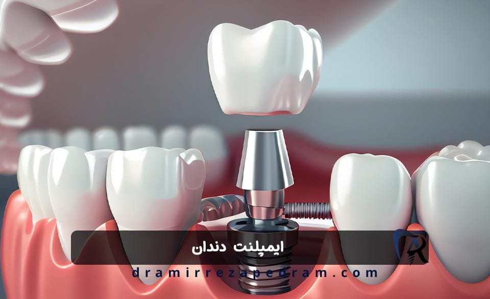 ایمپلنت دندان در ستارخان تهران
