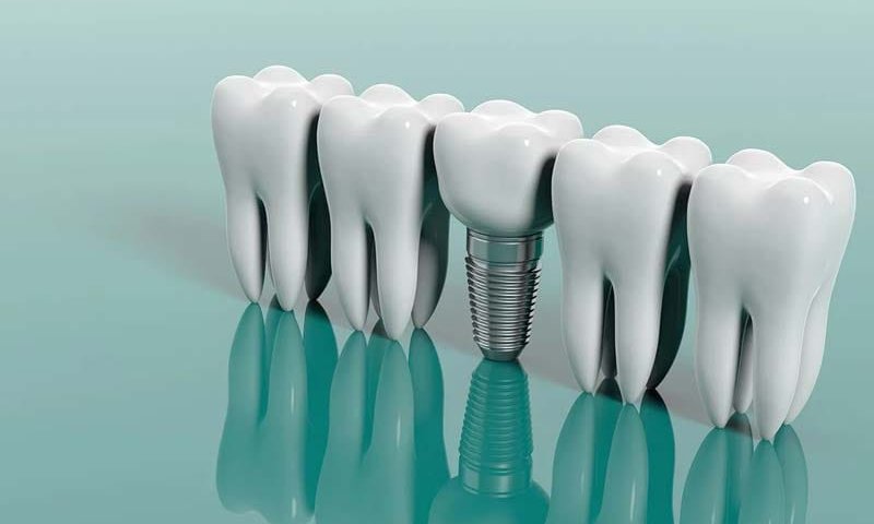 ایمپلنت دندان اس پی ای