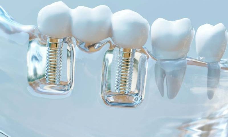 ایمپلنت بایکان Bicon