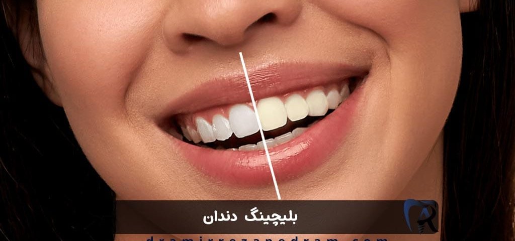 بلیچینگ دندان در ستارخان تهران
