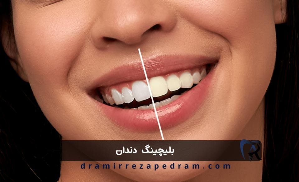 بلیچینگ دندان در ستارخان تهران