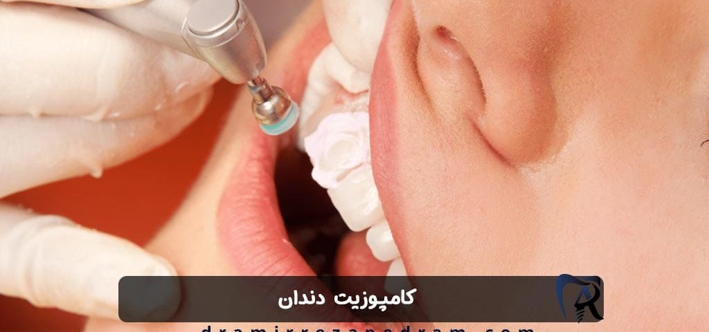 کامپوزیت دندان در ستارخان تهران