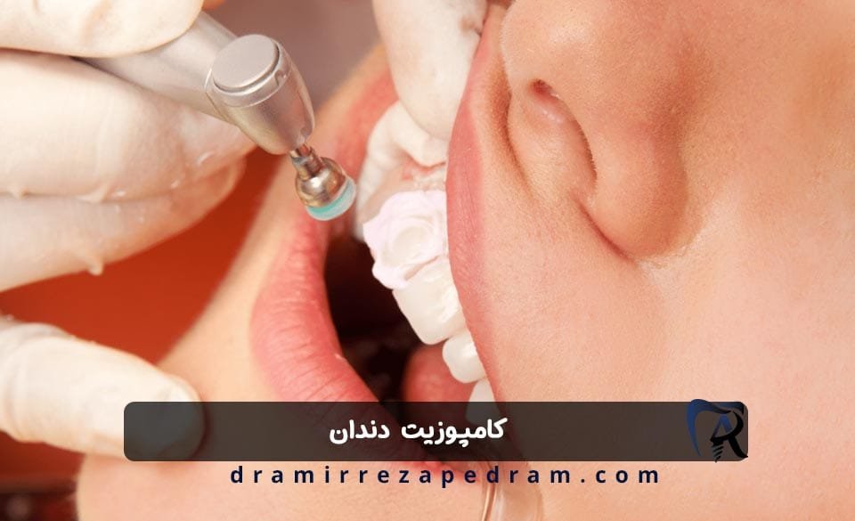 کامپوزیت دندان در ستارخان تهران