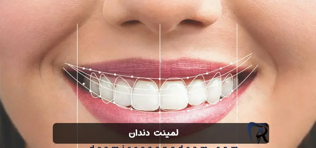 لمینت دندان در مرزداران