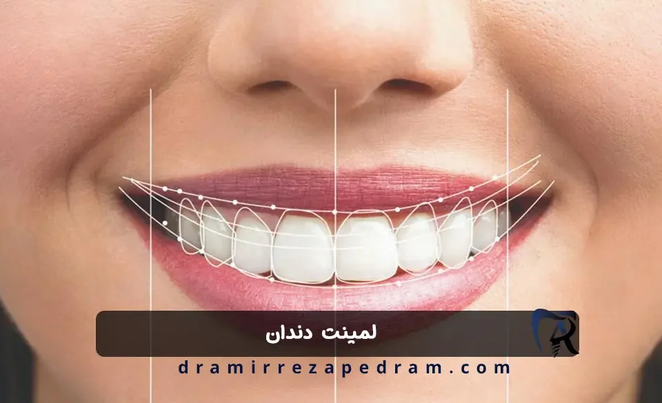 لمینت دندان در مرزداران