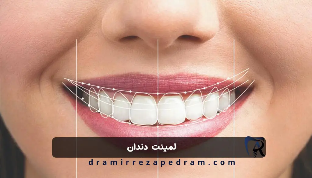 لمینت دندان در مرزداران