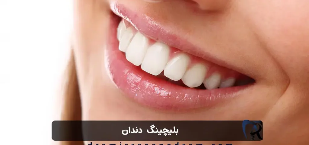 بلیچینگ دندان در مرزداران