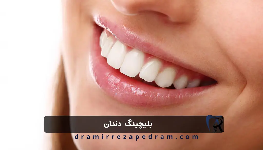 بلیچینگ دندان در مرزداران