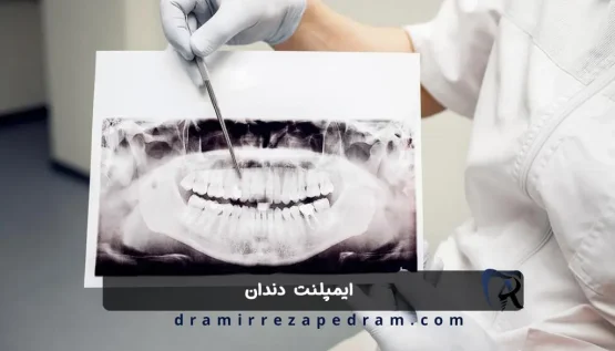 ایمپلنت دندان در مرزداران